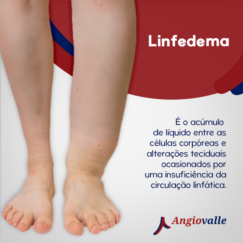 Linfedema Causas E Sintomas Angioviva
