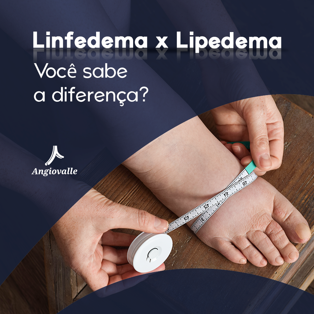Linfedema X Lipedema Você Sabe A Diferença Angioviva