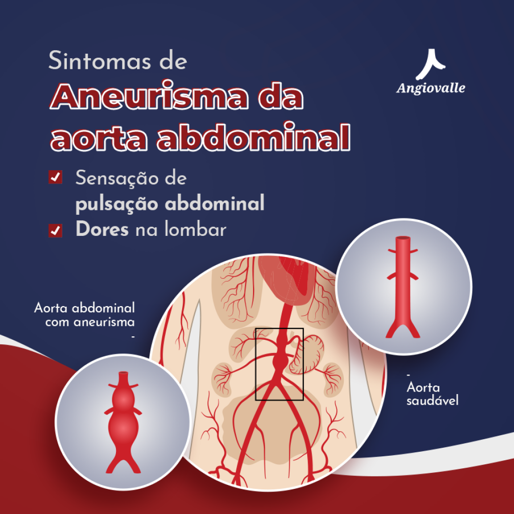 Sintomas de aneurisma da aorta abdominal - AngioViva