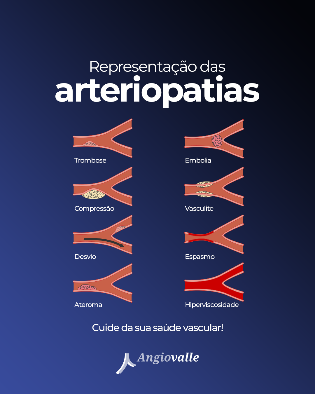 Representa o Das Arteriopatias AngioViva