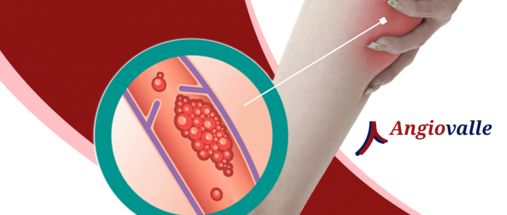 Você sabe o que é Flebite? - AngioViva